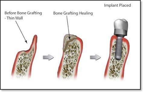 bone grafting the villages|Bone Grafting .
